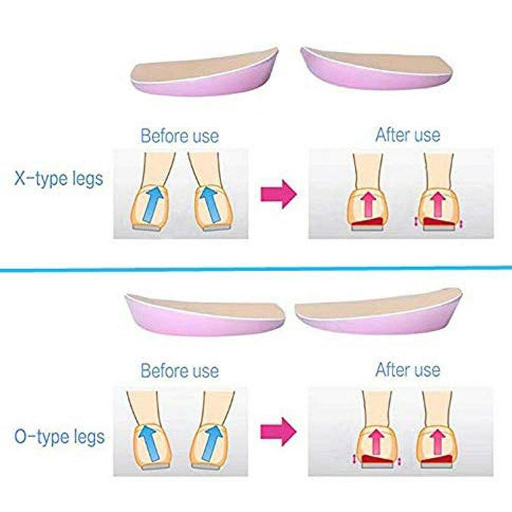 wtf Tcare X/O Legs Orthopedic Shoes Insoles Silicone Gel Arch Support Pad for Women Flat Foot Orthotic Inserts Pain Relief High Heel.